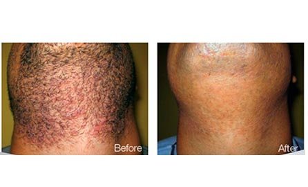 Laser Treatments