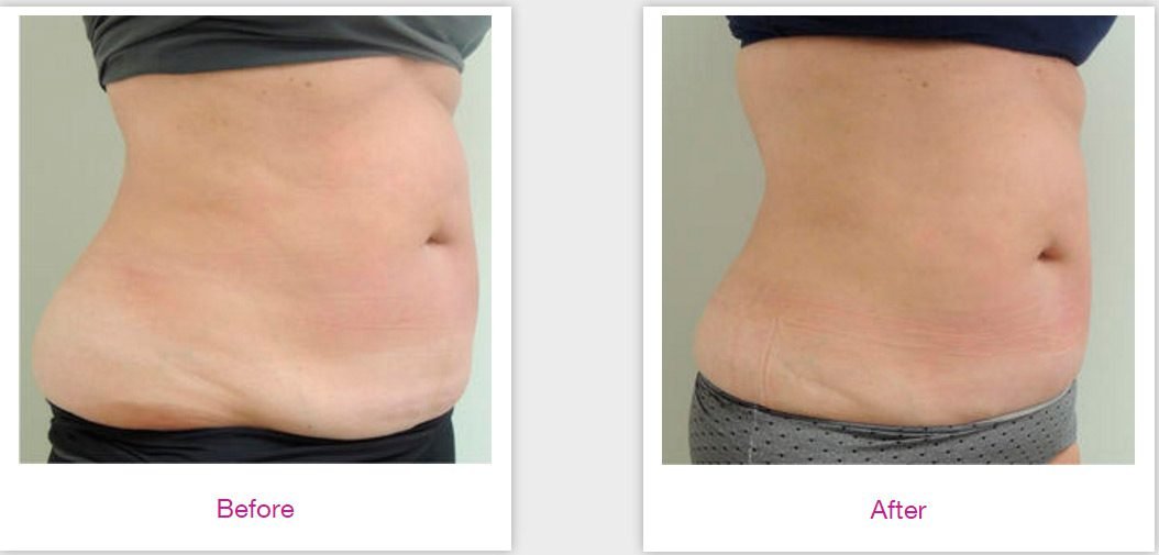 Results Velashape III