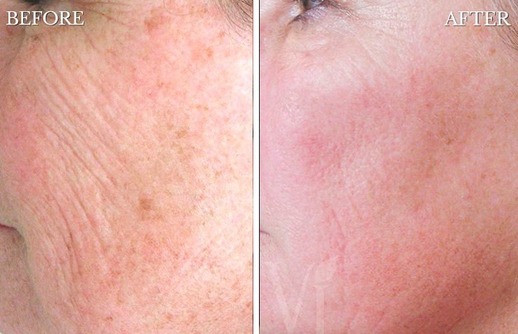 laser treatments