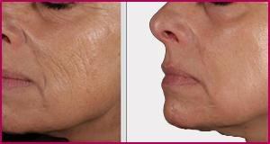 The Best Facial skin Tightening and Resurfacing