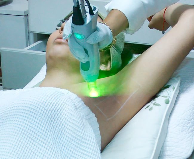 is laser hair removal really permanent