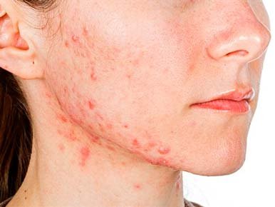 Laser Hair removal for acne areas