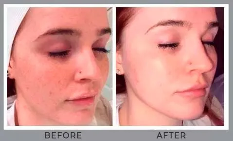 Dermaplaning Treatment