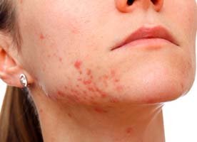 Acne treatments in Queens NY