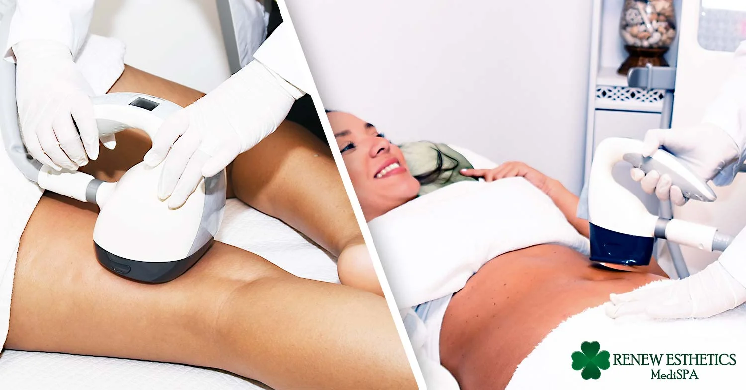 Amazing Benefits of Velashape 3  Renew Esthetics MediSpa Queens NY