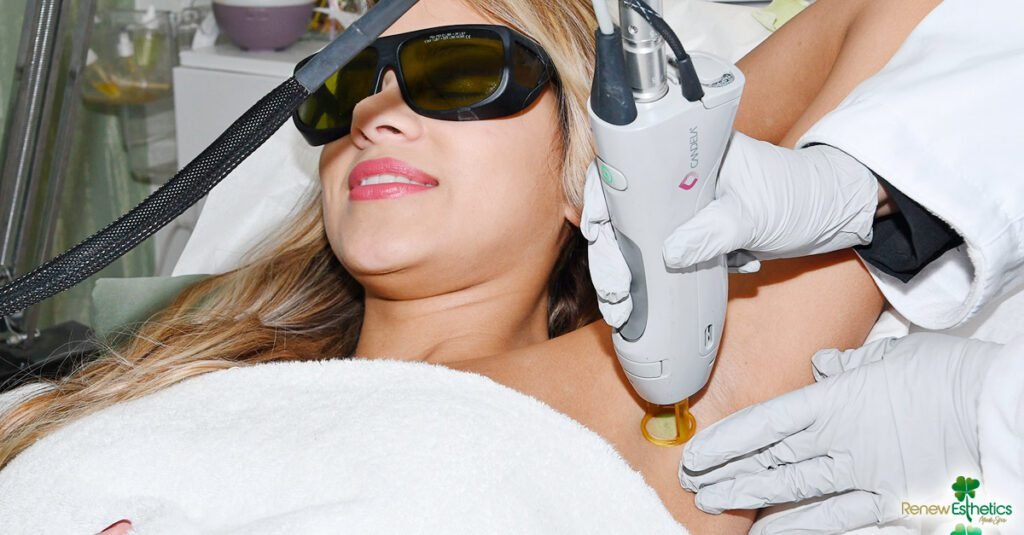 Laser Hair Removal in Summer