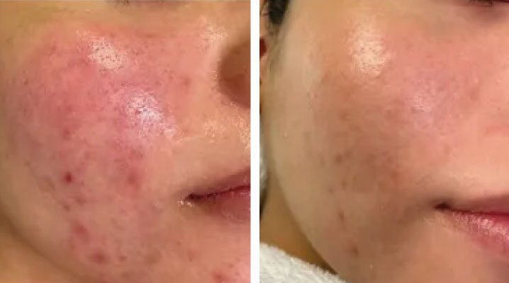 acne-treatment-before-and-after-2