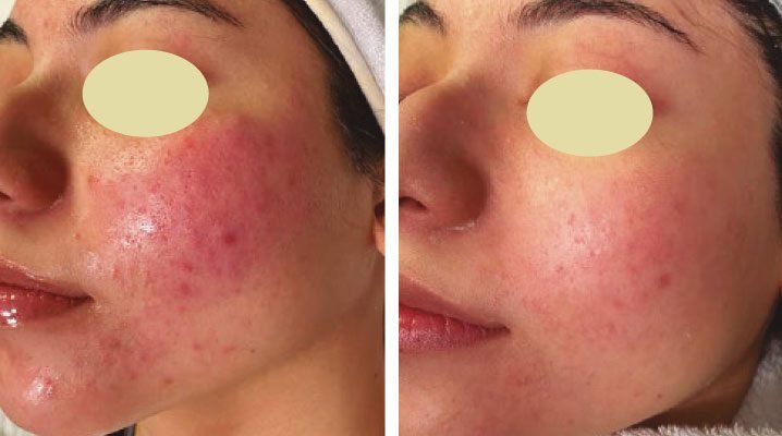 acne-treatment-before-and-after
