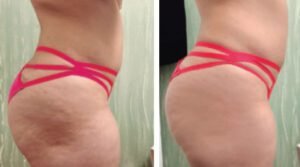 Non-invasive Body Sculpting & Fat Reduction