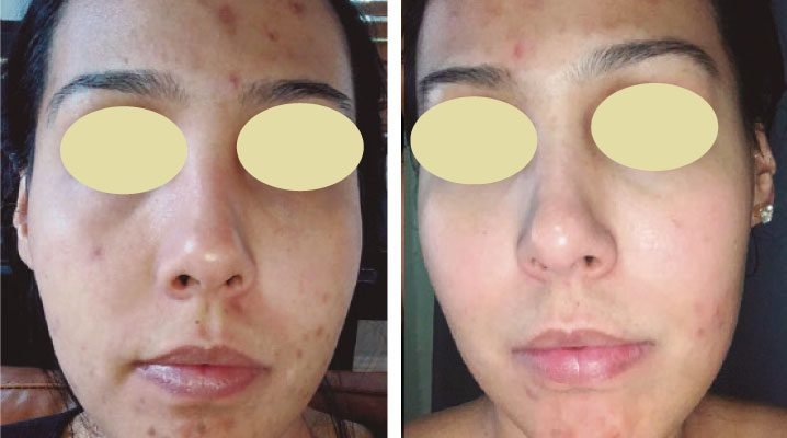 before-and-after-pigmentation-removal-2