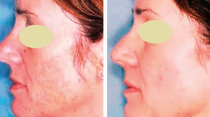 before-and-after-pigmentation-removal