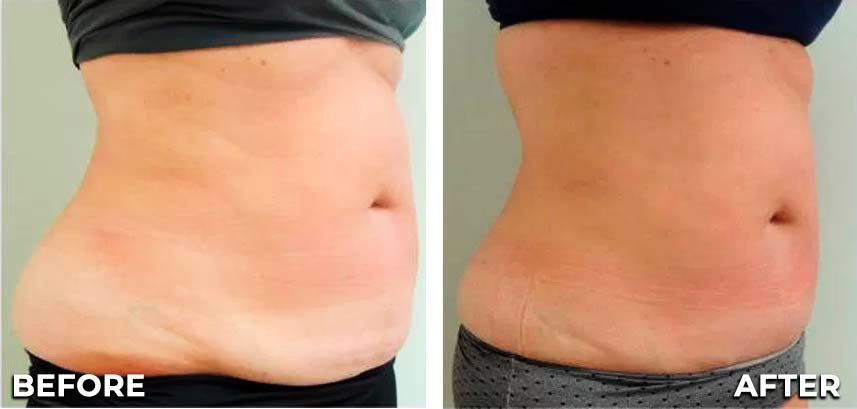 cellulite-treatment-before-and-after-1
