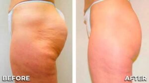 cellulite treatment