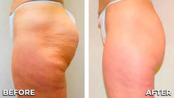 cellulite-treatment-before-and-after-2