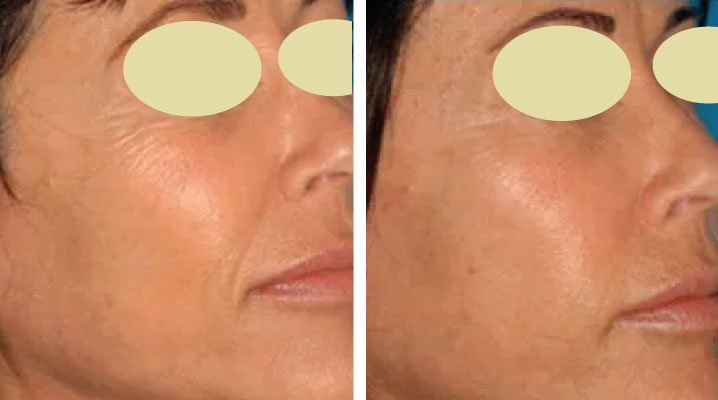 dermaplaning-before-and-after-1