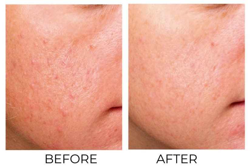 Microneedling Benefits